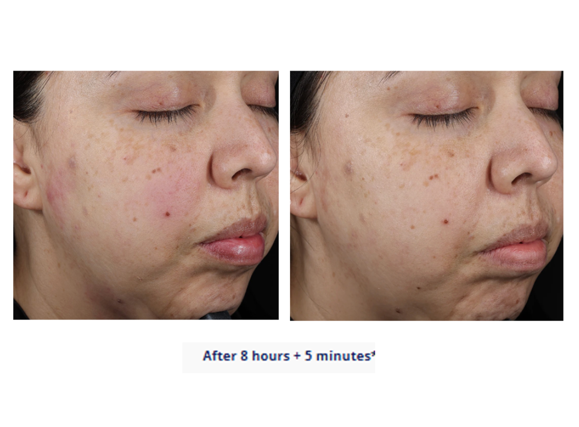 Suzan Obagi Moisture Restore